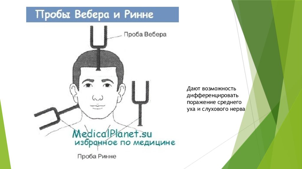 Проба вебера. - Камертональные пробы Ринне, Вебера, Швабаха. Проба Вебера и Ринне Вебера. Проба Вебера и проба Ринне. Проба Вебера Камертон.