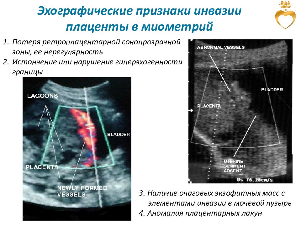 Эхографическая картина внутреннего эндометриоза