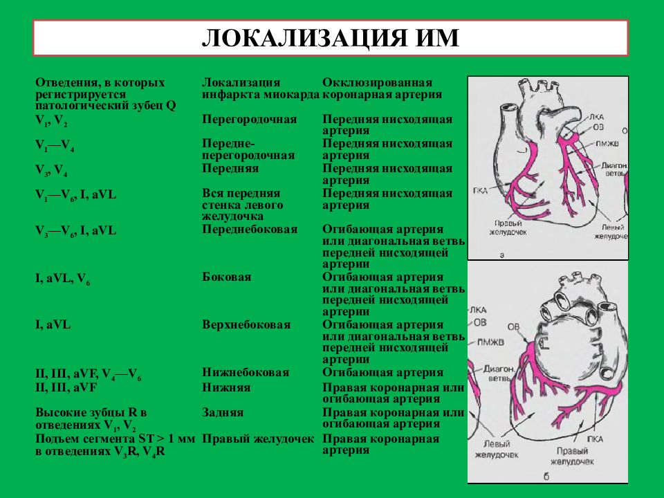 Стенки левого желудочка сердца. Инфаркт миокарда v1 v2. Локализация инфаркта миокарда по отведениям таблица. Отведения ЭКГ локализации инфаркта миокарда. Локализация инфаркта на ЭКГ.