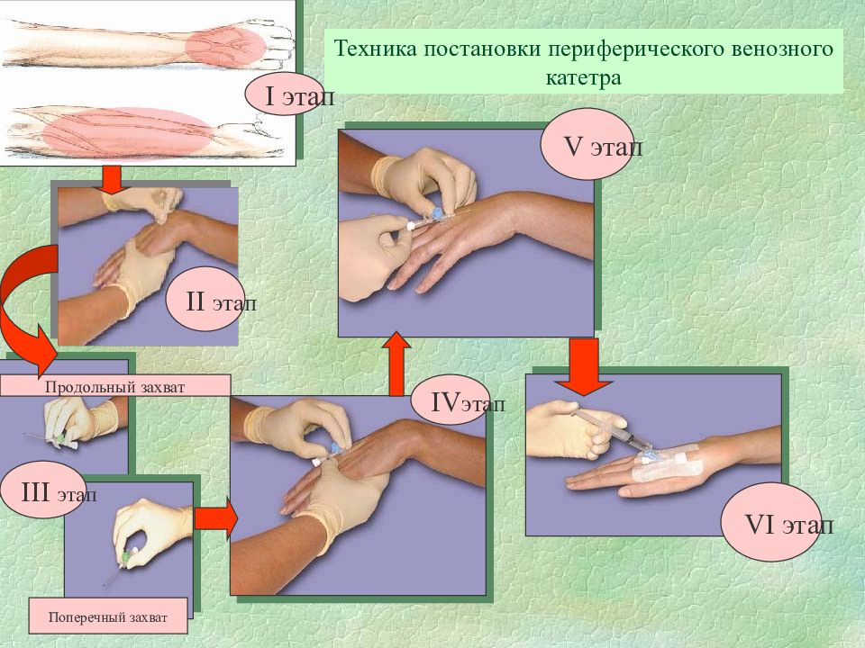 Схема постановки внутривенного катетера