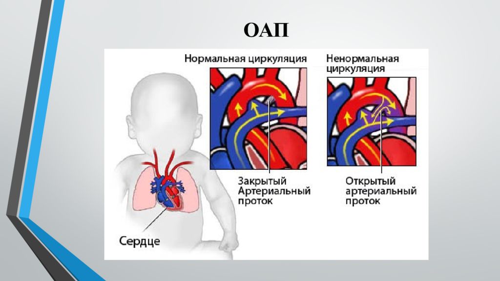 Презентация на тему пороки сердца