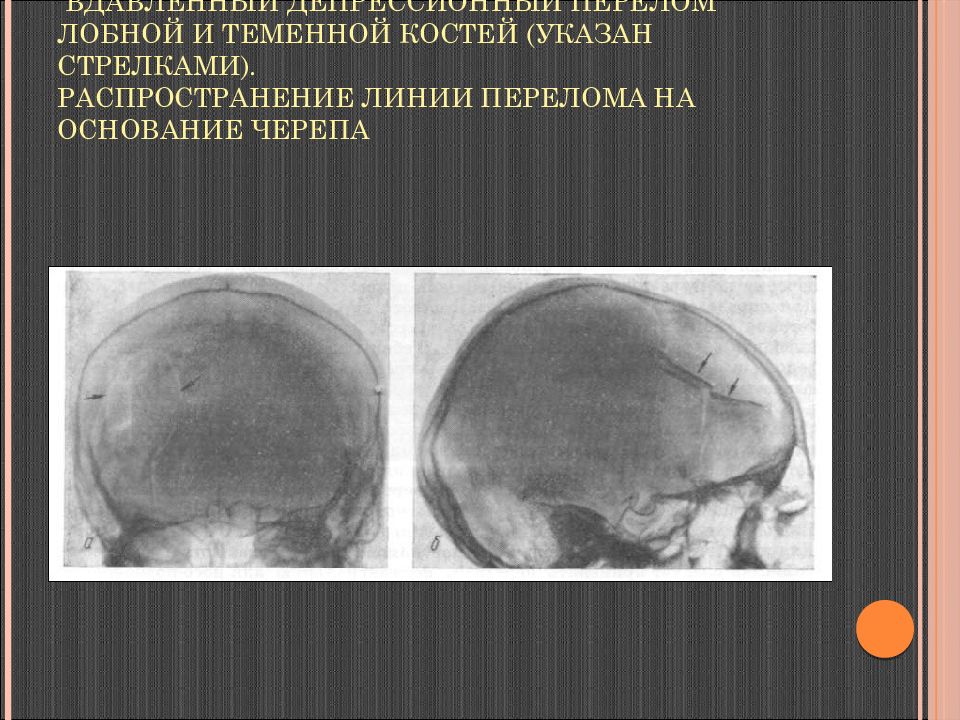 Перелом теменной кости у грудного. Импрессионный перелом черепа на кт. Вдавленный перелом теменной кости кт. Импрессионный перелом костей черепа. Импрессионный перелом свода черепа.