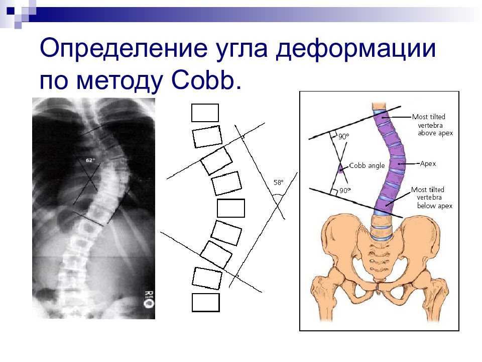 Сколиотическая болезнь травматология и ортопедия презентация