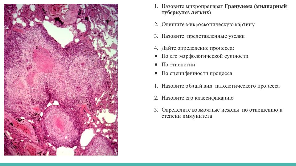 Описание микропрепарата. Милиарный туберкулез легких микропрепарат. Милиарный туберкулез легкого микропрепарат. Милиарный туберкулёз лёгких микропрепарат. Милиарный туберкулёз лёгкого микропрепарат.