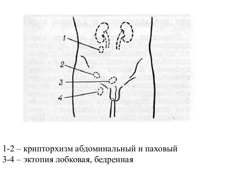 Крипторхизм презентация детская хирургия