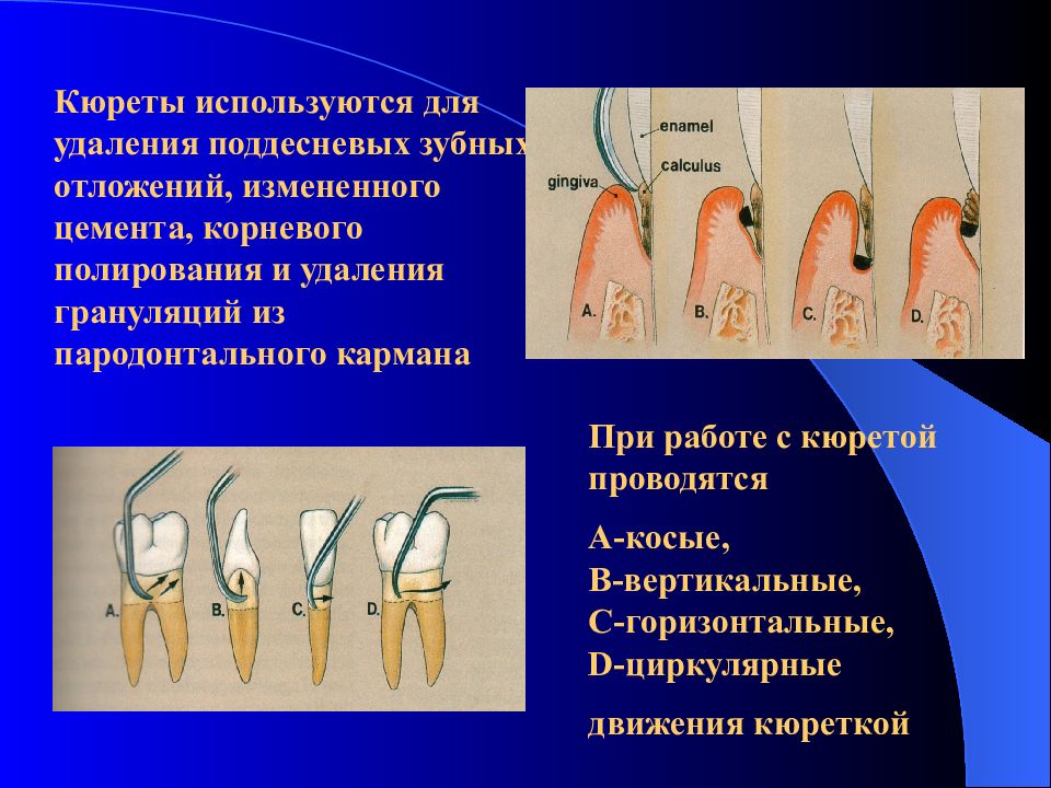 Удаление отложений. Инструменты для удаления поддесневых отложений. Кюреты используются для снятия. Перечислите инструменты для удаления наддесневых отложений.. Инструменты для снятия зубных отложений.