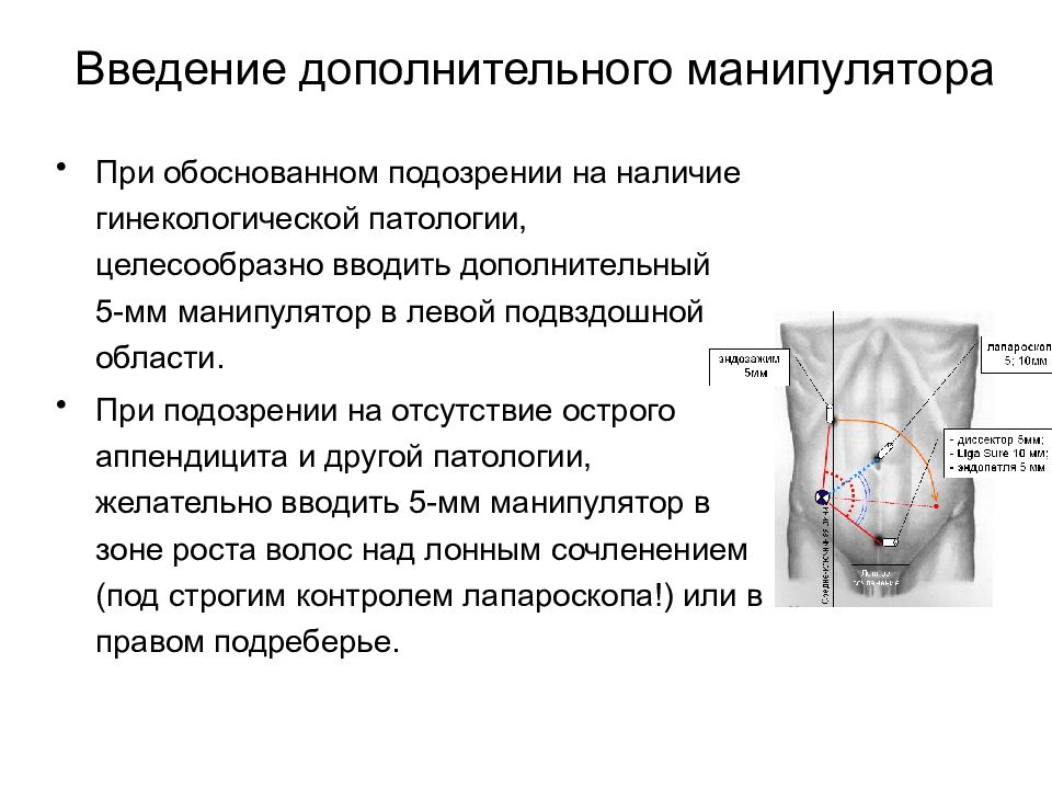 Протокол лапароскопической аппендэктомии. Этапы лапароскопической аппендэктомии. Аппендэктомия протокол операции.