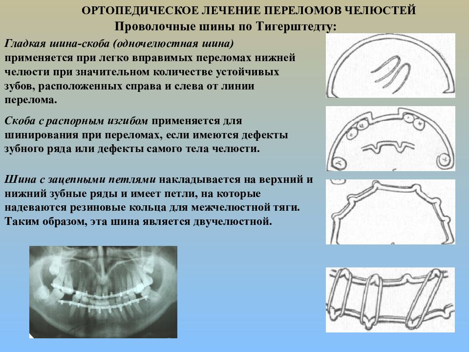 Виды ортопедического лечения. Шина скоба с распорочным изгибом. Перелом нижней челюсти шина Тигерштедта. Шина скоба Тигерштедта. Проволочная шина с зацепными петлями.