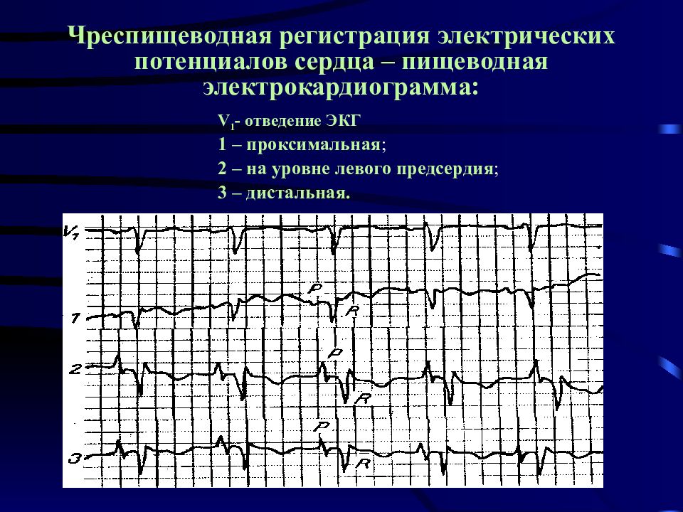 Экг презентация терапия