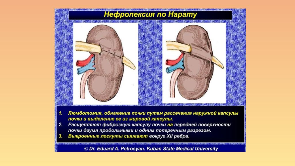 Нефропексия это