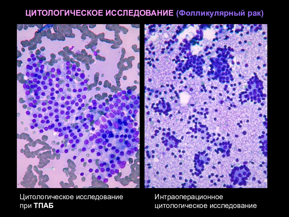 Цитологическая картина папиллярной карциномы щитовидной железы