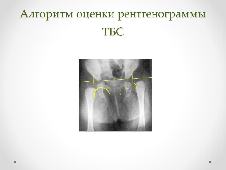 Алгоритм оценки рентгенограммы ТБС