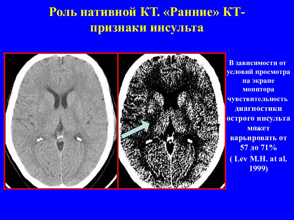 Кт признаки. Нативная мрт. Нативное исследование кт что это.