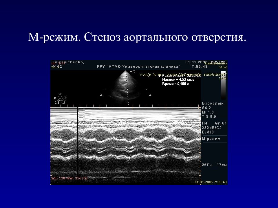 М режим. Аортальный стеноз ЭХОКГ. Эхокардиография при аортальном стенозе. Стеноз устья аорты ЭХОКГ. Эхо кг при аортальном стенозе.