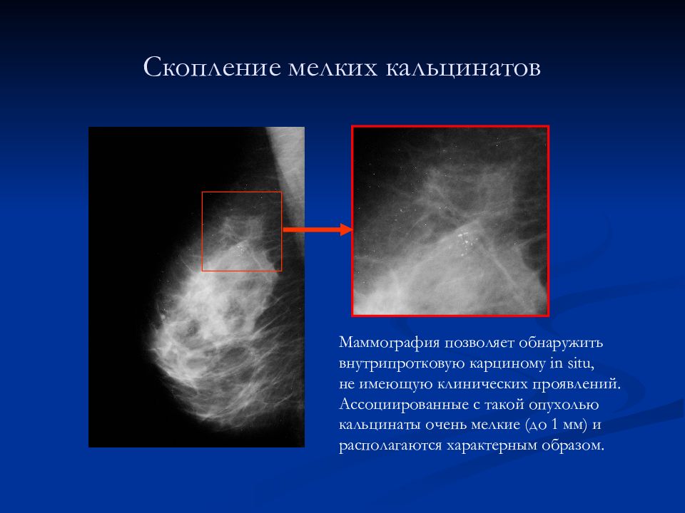 Микрокальцинаты. Маммограмма микрокальцинаты. Микрокальцинаты молочной железы рентген. Внутрипротоковые кальцинаты молочных желез. Доброкачественные кальцинаты молочной железы.