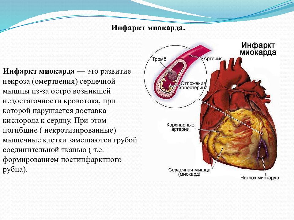 Инфаркт миокарда на картинке