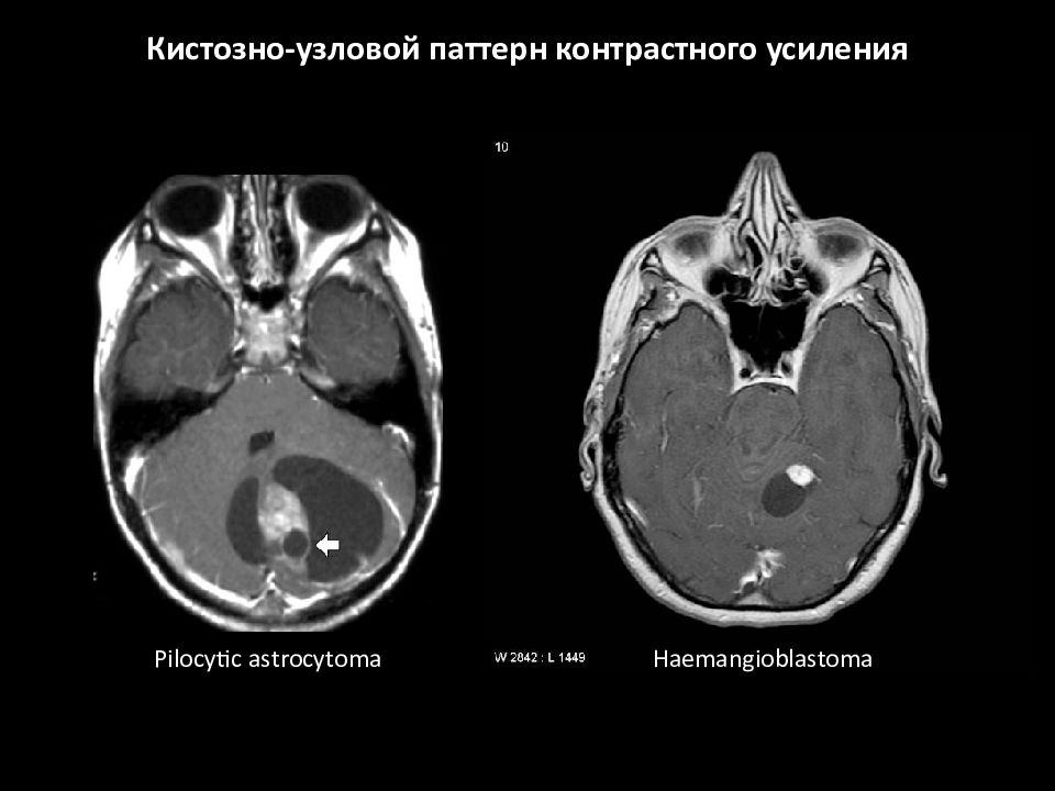 Мрт с контрастным усилением. Кт с контрастным усилением. Контрастное усиление при кт. Усиленная кт это.