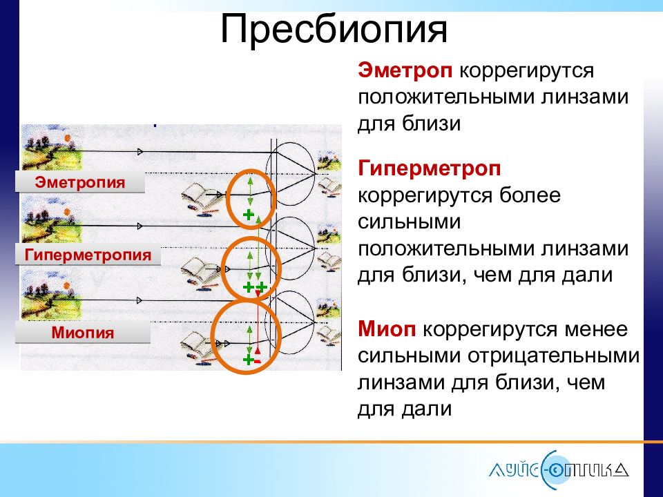 Что такое пресбиопия. Гиперметропия классификация. Степени гиперметропии классификация. Пресбиопия классификация. Пресбиопия степени.