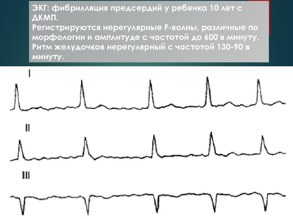 Купирование предсердий. Мерцательная аритмия у детей. Дилатационная кардиомиопатия ЭКГ. Мерцание предсердий у детей. Мерцательная аритмия у грудничка.