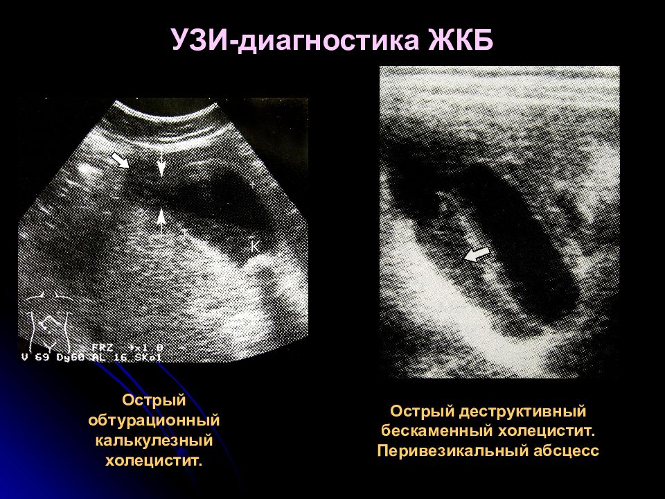 Острый калькулезный холецистит презентация