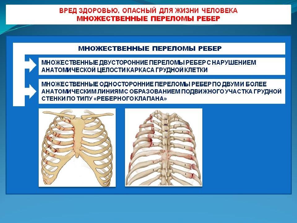 Перелом тяжесть вреда. Перелом ребер степень тяжести. Перелом ребер тяжесть вреда здоровью. Билатеральные переломы ребер. Опасный для жизни вред здоровью.