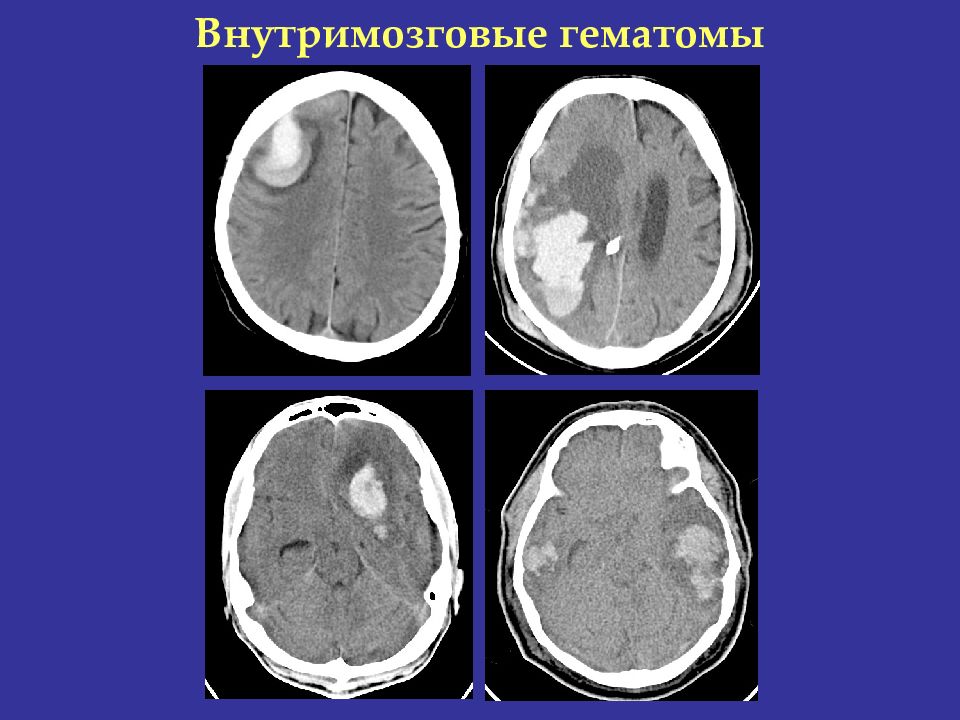 Гематома черепно мозговой травме. Внутримозговая гематома классификация кт. Внутримозговая гематома при ЧМТ кт.