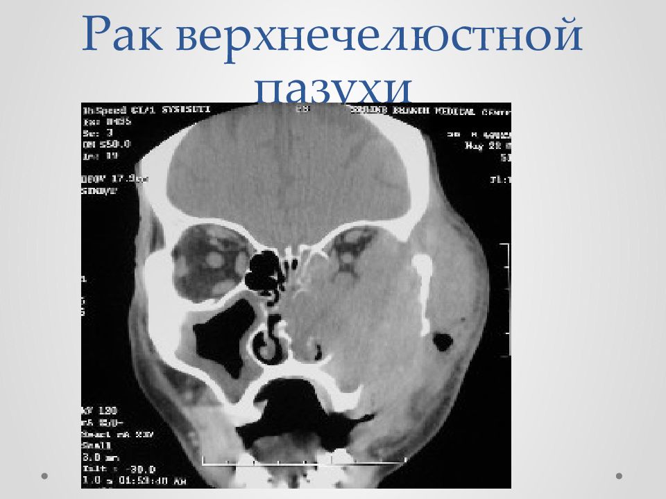 Рак полости носа и придаточных пазух презентация