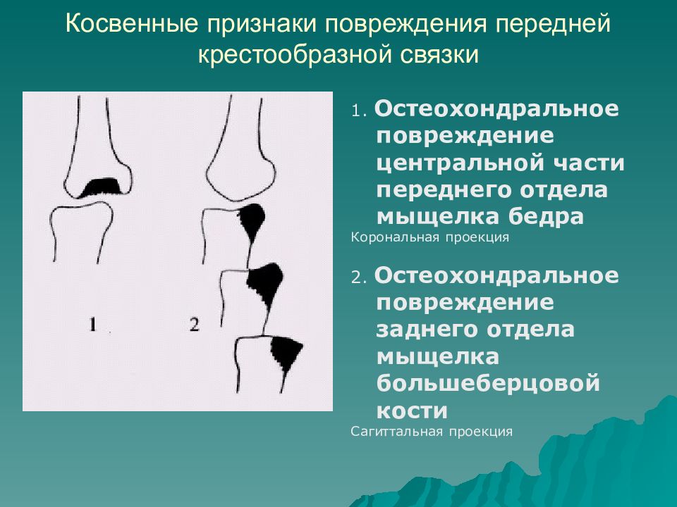 Повреждения мыщелка