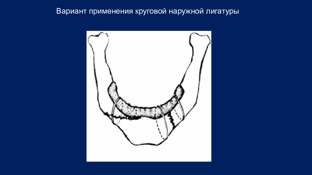 Методы временной и постоянной иммобилизации отломков челюстей презентация