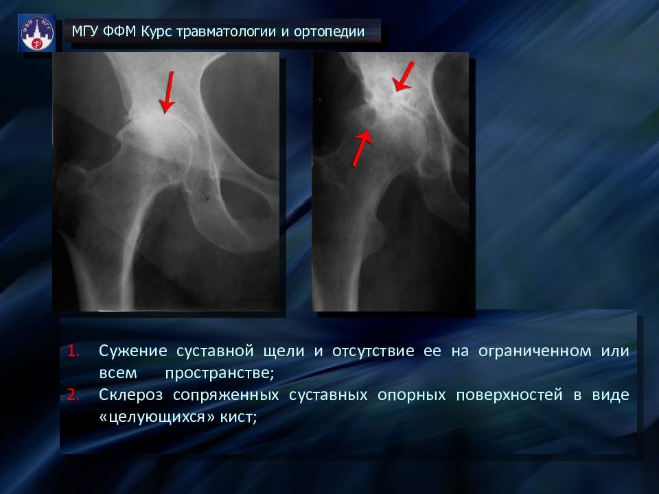 Левый тазобедренный сустав. Дегенеративные изменения тазобедренных суставов. Проекция суставной щели тазобедренного сустава. Эндопротезирование тазобедренного сустава шов. Дегенеративные изменения тазобедренных суставов на рентгене.