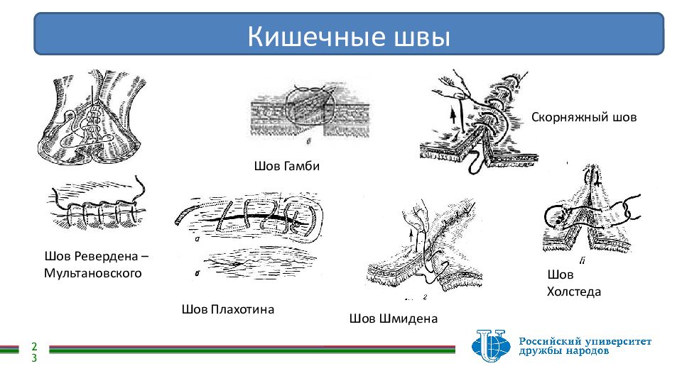 Кишечные швы. Кишечный шов Плахотина-Садовского. Кишечный шов Ревердена Мультановского. Кишечные швы Плахотина.