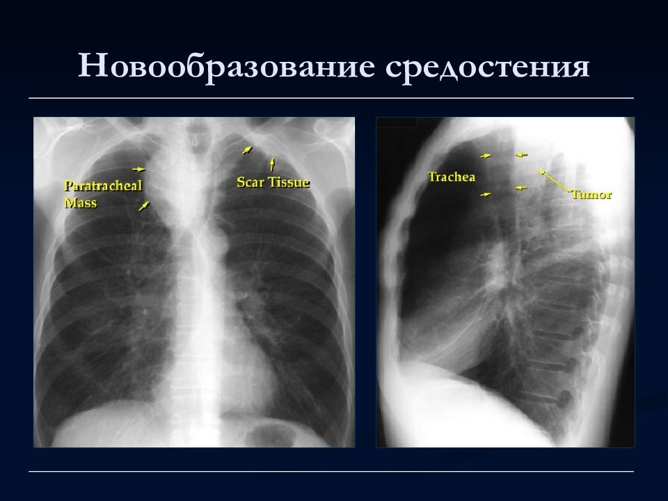 Лучевая диагностика органов средостения презентация