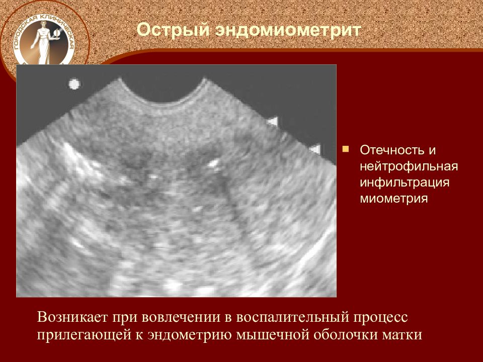 Эндометрия стенок матки. Послеродовый эндометрит. Эндомиометрит (метроэндометрит). Послеродовый эндометрит УЗИ матки.