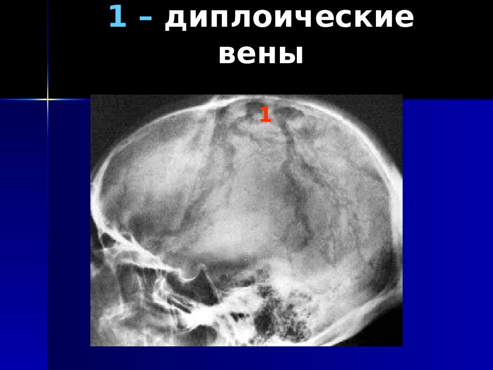 Усиление сосудистого рисунка. Диплоические вены черепа. Диплоические вены черепа рентген. Диплоические вены рентген. Каналы диплоических вен.