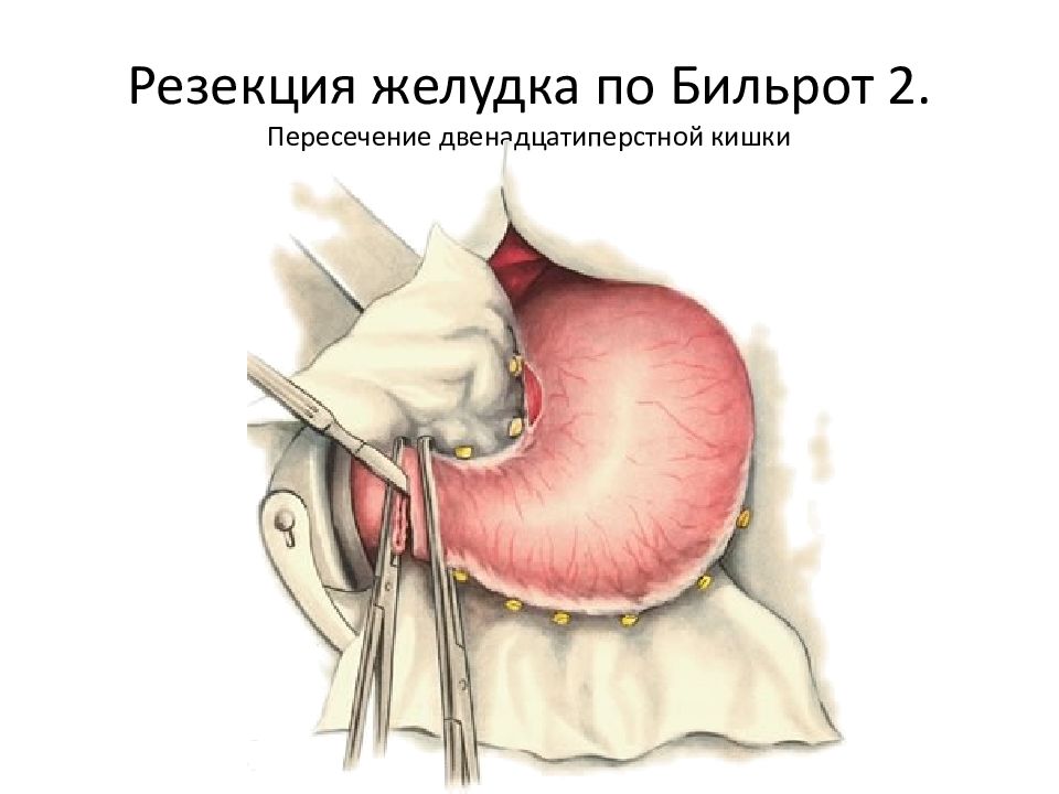 Резекция желудка картинки