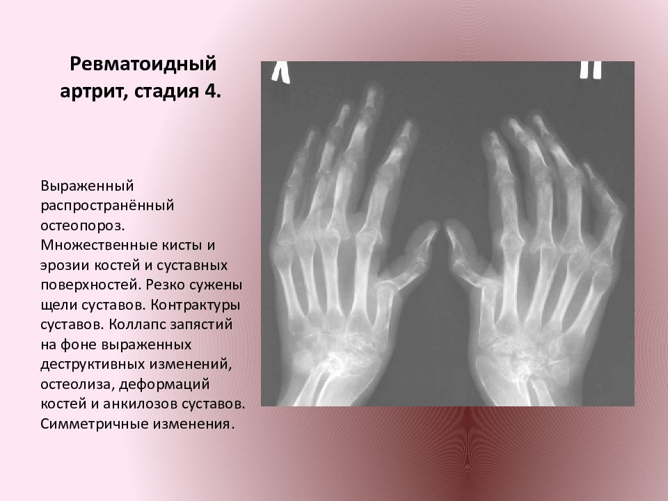 Ревматический полиартрит рентгенологическая картина