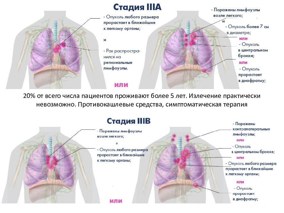 Рак легкого презентация онкология