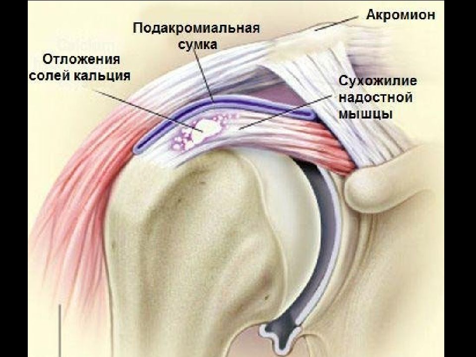 Боли дельтовидной мышцы плечевого сустава