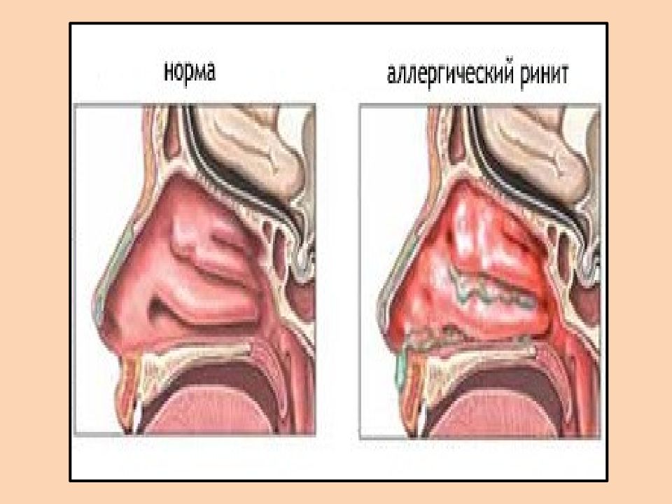 Острый ринит картинки