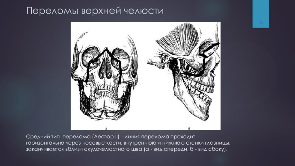 Переломы костей верхней челюсти. Лефор классификация переломов верхней челюсти. Переломы верхней челюсти Лефор 2 рентген. Перелом верхней челюсти Лефор 3. Рентген перелома верхней челюсти Ле фор 1.