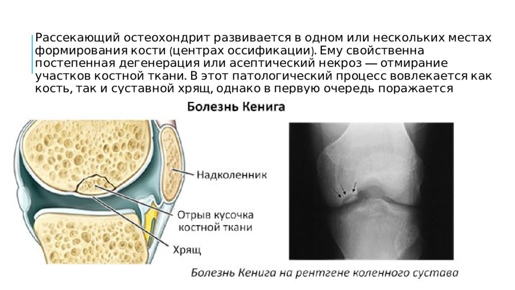 Болезнь кенига. Болезнь Кенига коленного. Болезнь Кенига коленного сустава стадии. Колено болезнь Кенига коленного сустава. Болезнь Кенига коленного сустава степени.