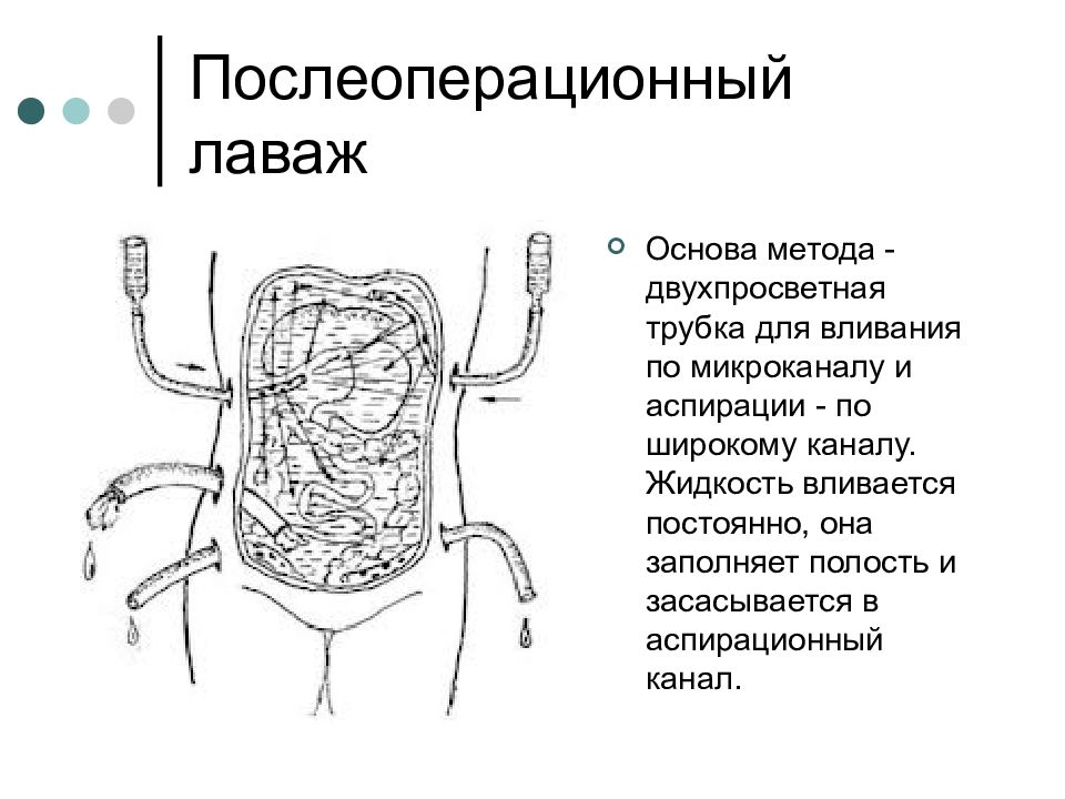 Схема дренирования брюшной полости при перитоните