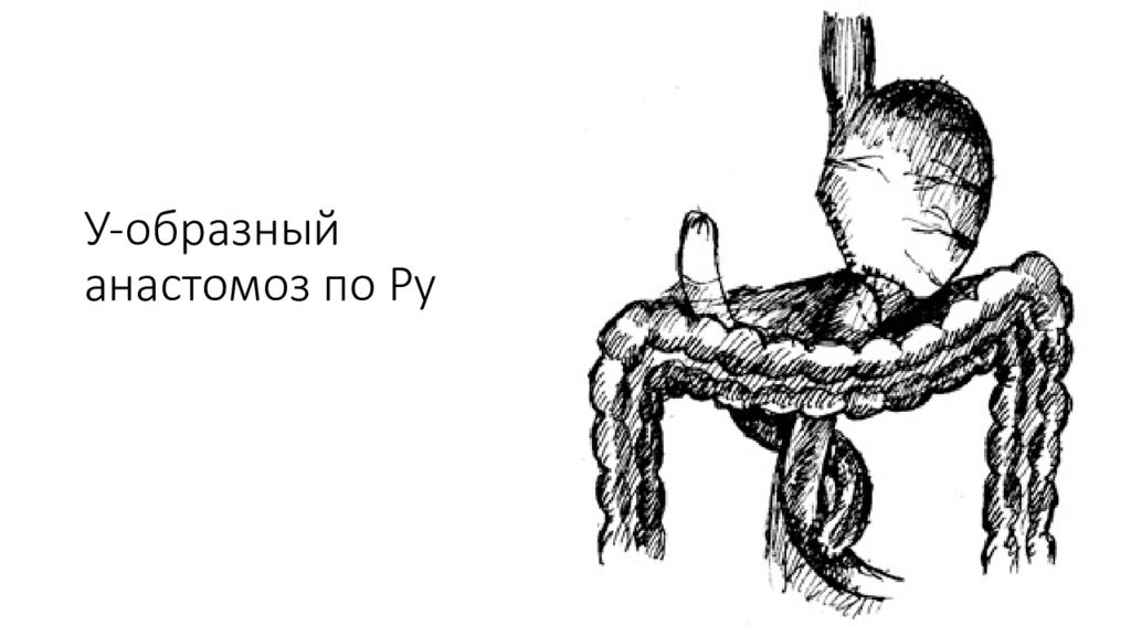 Анастомоз по ру схема