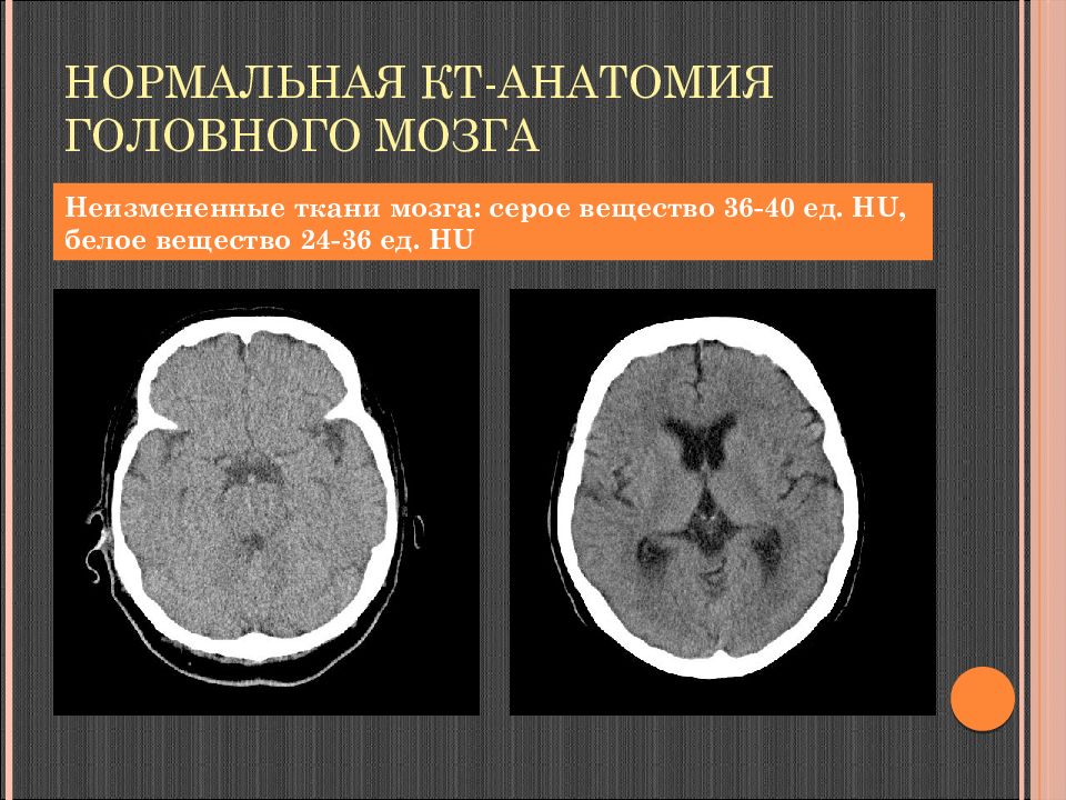 Структура белого вещества головного мозга. Структуры серого вещества головного мозга. Кт анатомия головного мозга. Кт головного мозга. Нормальное кт головного мозга.