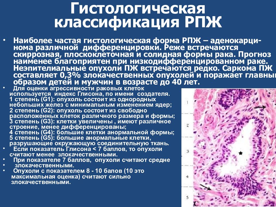 Рак предстательной железы метастазы прогноз. Гистологическая классификация опухолей предстательной железы. Классификация РПЖ. Опухоли предстательной железы лекция. Классифткациярака предстательной.