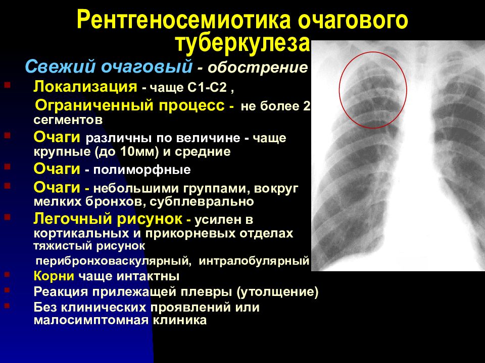 Очаговый туберкулез презентация