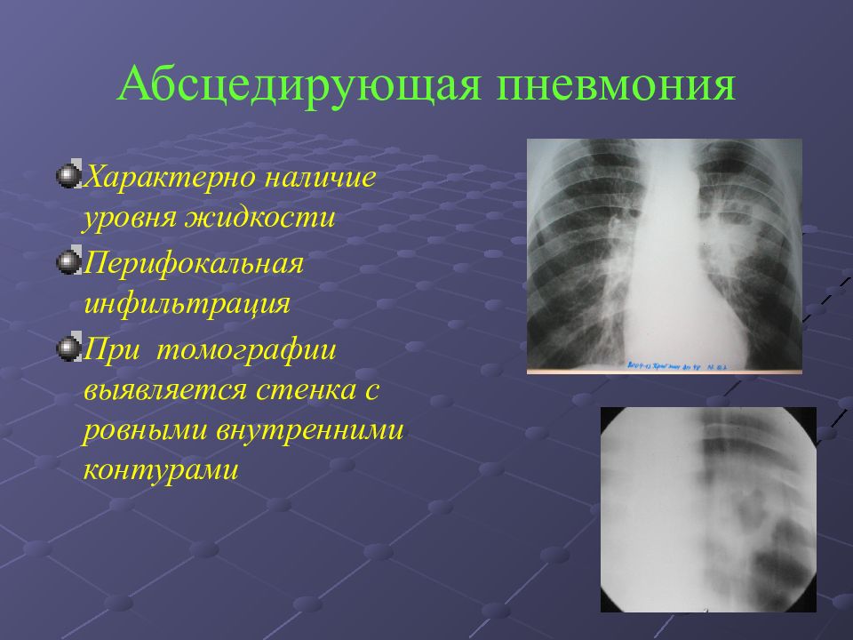 Рентгенологическая картина пневмонии