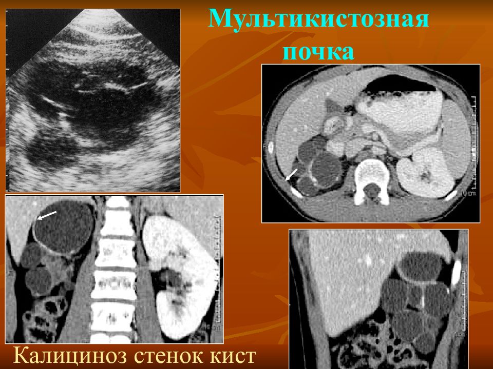 Дисплазия почки презентация