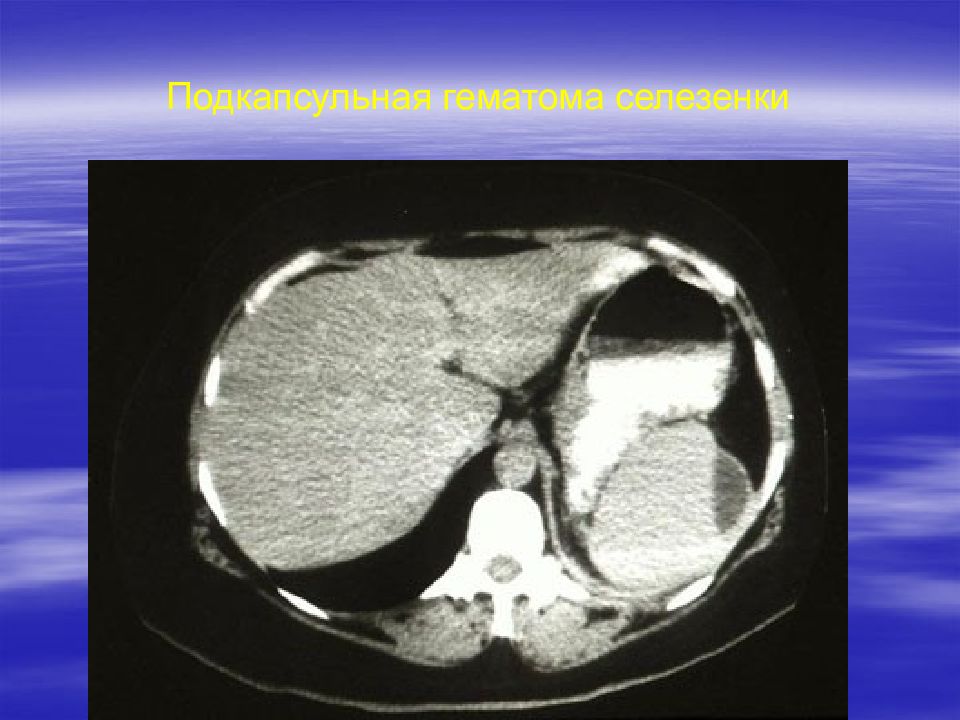 Кт можно. Подкапсульный разрыв селезенки кт. Подкапсульная гематома селезенки. Субкапсулярная гематома селезенки кт.