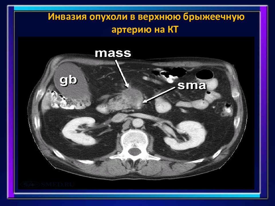 Рак хвоста поджелудочной. Опухоль поджелудочной железы на кт. Опухоль головки поджелудочной железы на кт. Тело и хвост поджелудочной железы на кт.